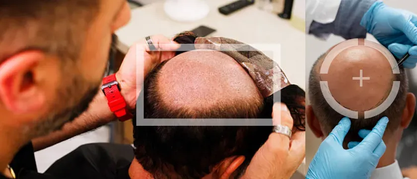 Hair Patch in Raipur